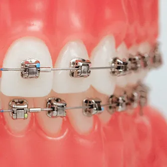 self ligating braces